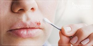 درمان خانگی تبخال