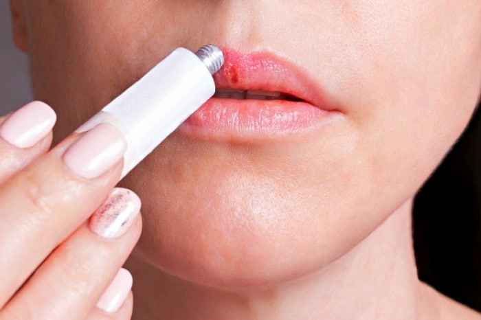 درمان تبخال